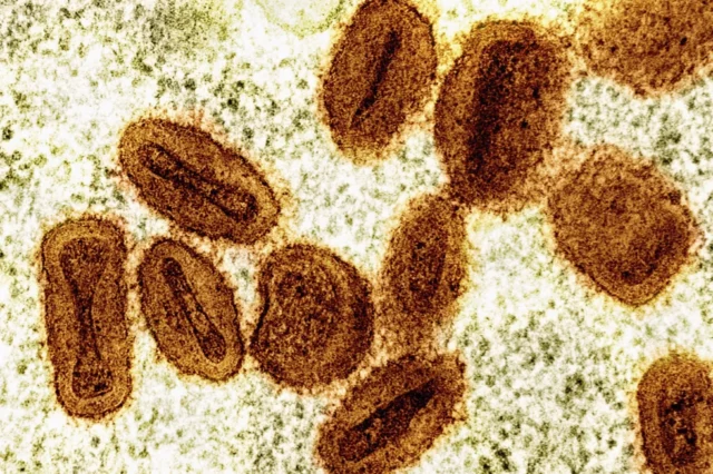 ARQUIVO - Esta imagem de microscópio eletrônico colorida fornecida pelo Instituto Nacional de Alergia e Doenças Infecciosas em 2024 mostra partículas do vírus Mpox, laranja, encontradas dentro de células infectadas, verde. (NIAID via AP, arquivo)